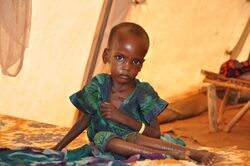 A malnourished child in an MSF treatment tent in Dolo Ado.jpg