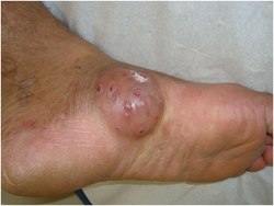 Actinomycetoma before treatment.tif