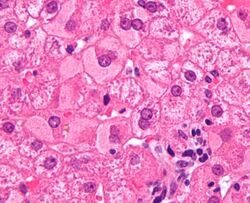 Ground glass hepatocytes high mag cropped 2.jpg