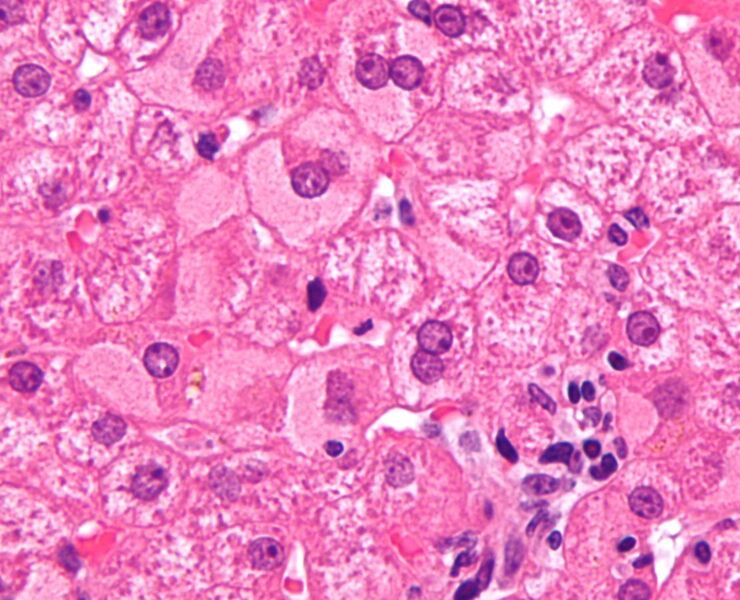File:Ground glass hepatocytes high mag cropped 2.jpg