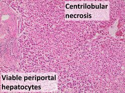 Histopathology of early centrilobular hepatic necrosis of shock liver (intermediate magnification).jpg