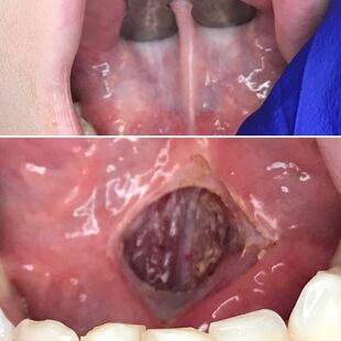 Lingual Frenectomy - Before and After.jpg