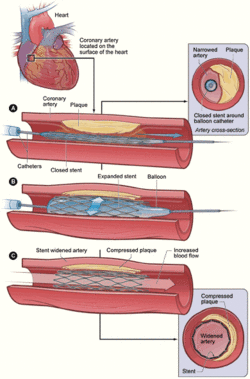 PTCA stent NIH.gif