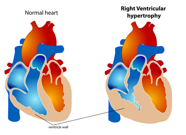 Medicine:Ventricular hypertrophy - HandWiki