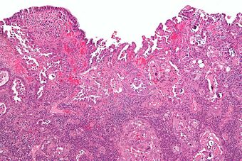 Uterine papillary serous carcinoma low mag.jpg