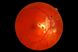 Presumed ocular histoplasmosis syndrome-11192007.png