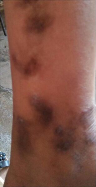 File:Scars of yaws lesions on the legs of a female patient with a history of yaws skin lesions in childhood and positive non-treponemal and treponemal antibodies (latent yaws).jpg