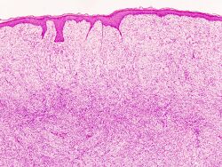 Dermatofibrosarcoma protuberans (1) recurrence.JPG