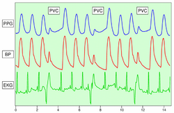 PVC detectionUsing PGG.png