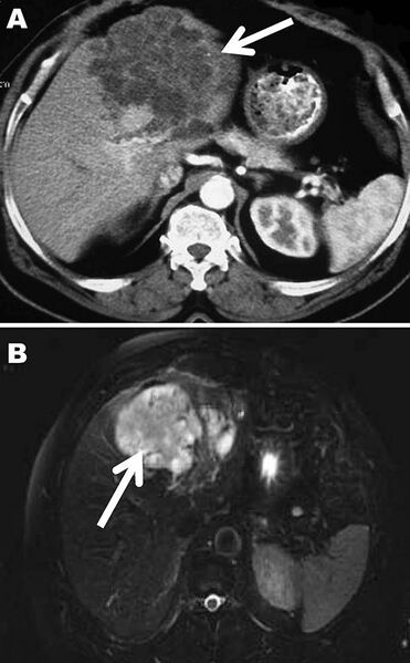 File:Polycystic echinococcosis affecting the left side of the liver.jpg