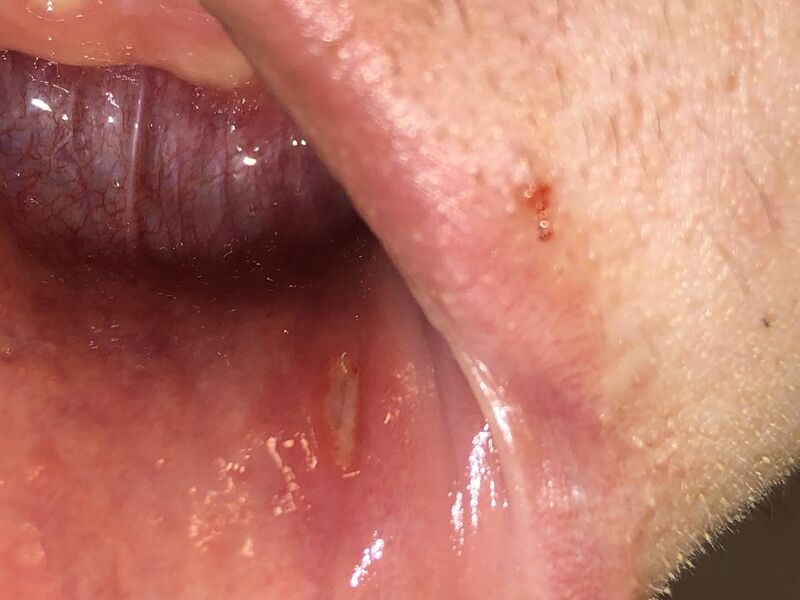 File:Aphthous Stomatitis in the mouth.jpg