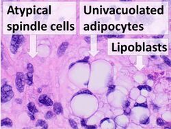 Histopathology of liposarcoma, annotated.jpg