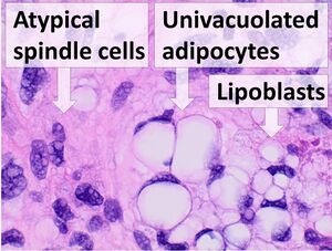 Histopathology of liposarcoma, annotated.jpg