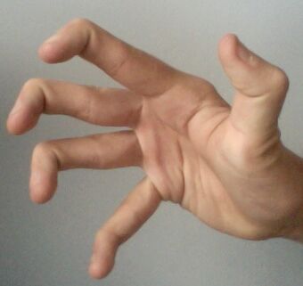 Hypermobile fingers and thumb.jpg