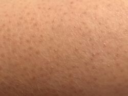 Keratosis pilaris (moderate).jpg