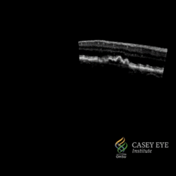 Optical coherence tomography of human retina.gif