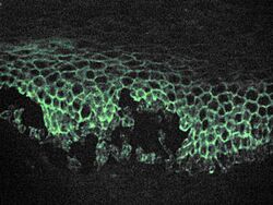 Pemphigus immunofluorescence.jpg