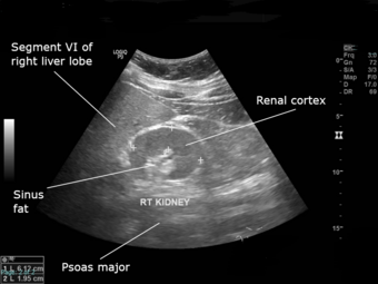 Ultrasound showing hypoplastic right kidney.png