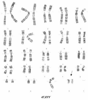 Amniocentesis results showing 47, XYY karyotype.png