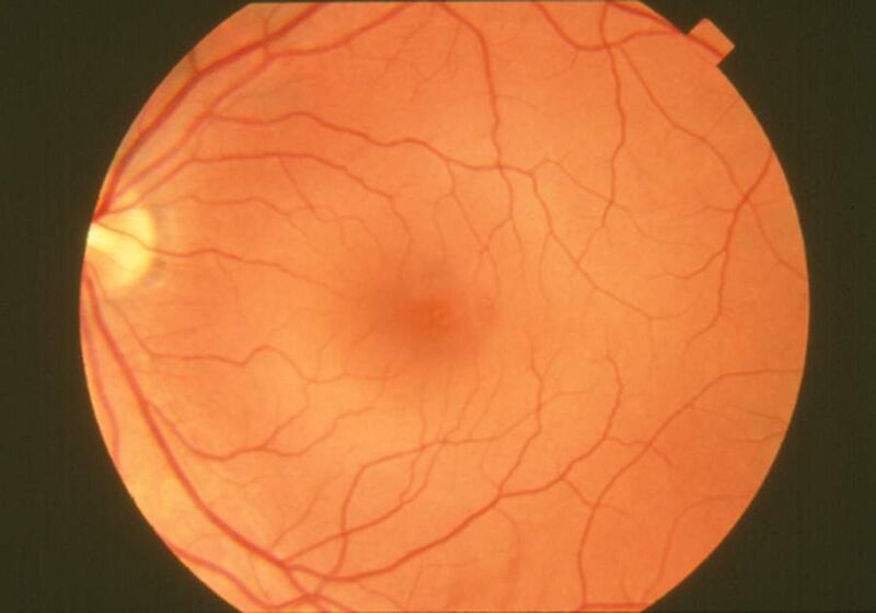 File:Fundus photograph-normal retina EDA06.JPG