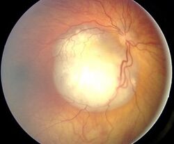 Fundus retinoblastoma.jpg
