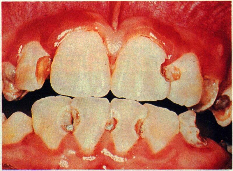 File:Tooth erosion 2.jpg