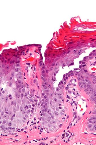 Transient acantholytic dermatosis - very high mag.jpg