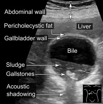 Ultrasonography of sludge and gallstones, annotated.jpg