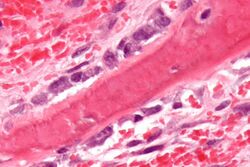 Bone hypercalcemia - cropped - very high mag.jpg