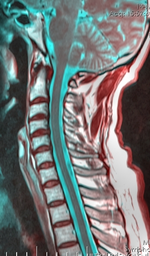 Cervical spine 125153 rgbca 67m.png