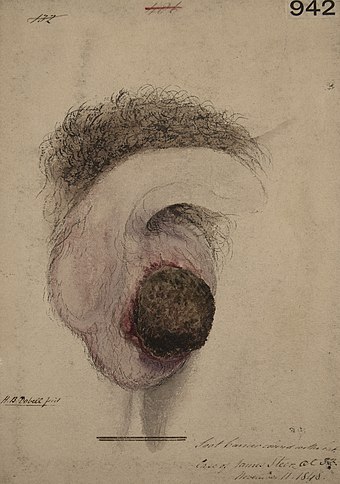 Drawing of a pair of testicles below a patch of pubic hair and a partially-drawn penis. A dark brown lump on the larger testicle is surrounded by red inflammation.