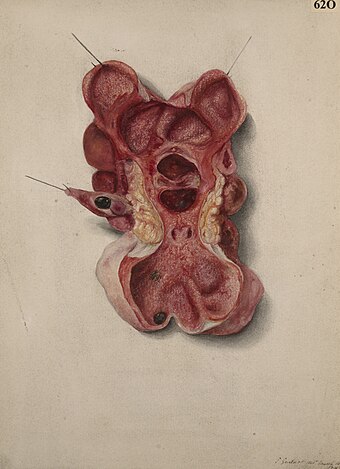 Kidney showing a condition of acute pyonephrosis Wellcome L0061752.jpg