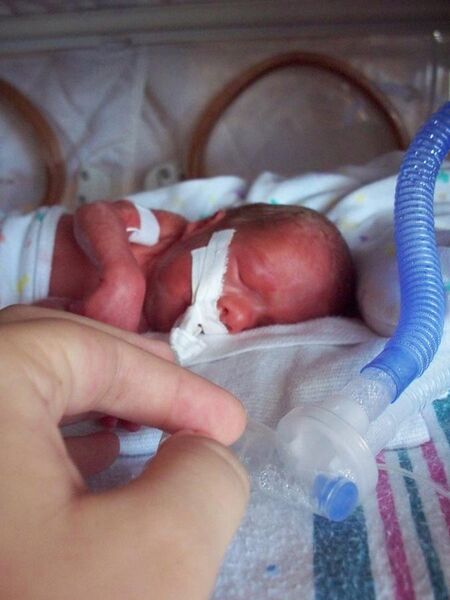 File:Premature infant with ventilator.jpg