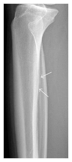 X-ray of subtle periosteal raction of tibial fracture.jpg