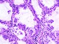 Brochiolo-alveolar carcinoma with mucin production (1).jpg