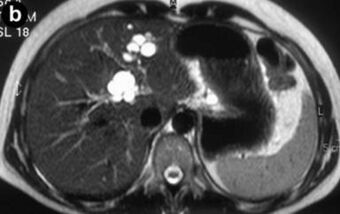 MRI of Caroli disease (b).jpg