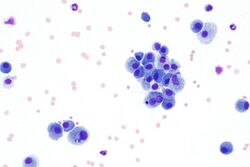 Macrophages in bronchial wash specimen -- high mag.jpg