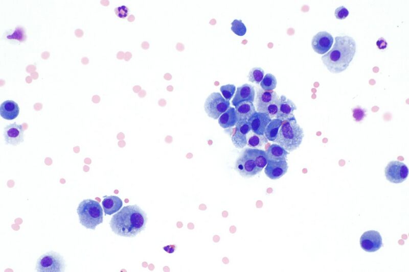 File:Macrophages in bronchial wash specimen -- high mag.jpg