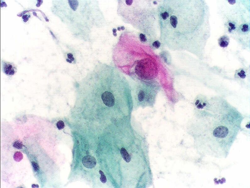 File:Pap test abnormal.JPG