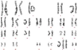 XXXYY syndrome karyotype.jpg