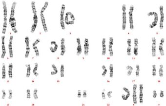 XXXYY syndrome karyotype.jpg