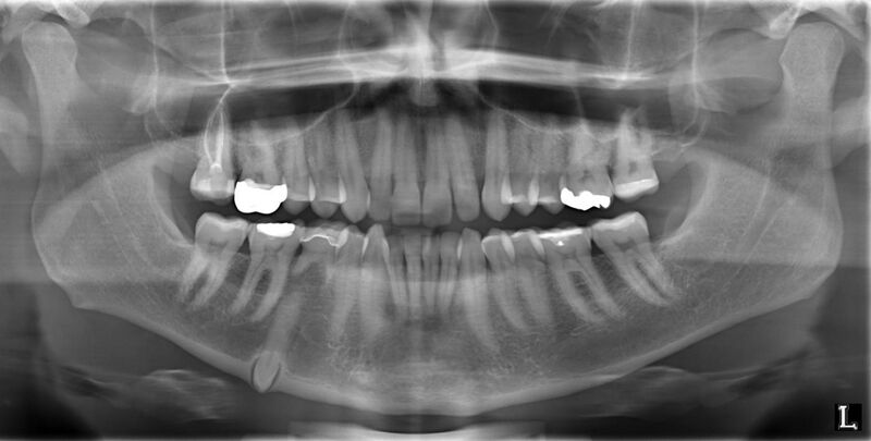 File:Milk-tooth and impacted inverted 2nd premolar.jpg