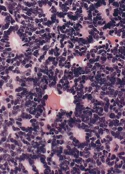 Retinoblastoma rosette.jpg