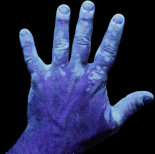 File:Vitiligo UV 1.jpg