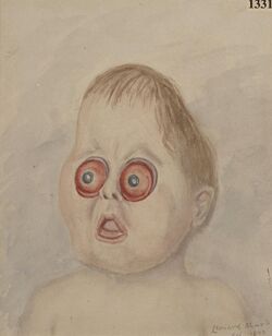 Child with extreme congenital proptosis and microcephalus Wellcome L0062479.jpg