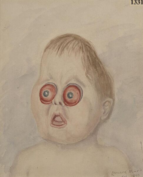 File:Child with extreme congenital proptosis and microcephalus Wellcome L0062479.jpg