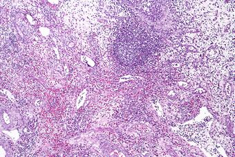 Eosinophilic cystitis, intermed. mag.jpg