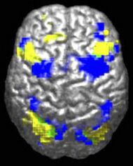 A human brain viewed from above. About 10% is highlighted in yellow and 10% in blue. There is a tiny green region (~0.5%) where they overlap.