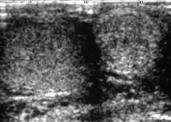 Scrotal ultrasonography of adenomatoid tumor at epididymis.jpg