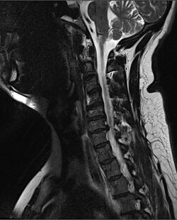 C6-C7-disc-herniation-cevical-mri-scan-cropped.jpg